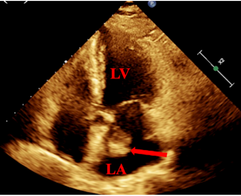 Disappeared left atrial “myxoma”: Left atrial thrombus was misdiagnosed as myxoma